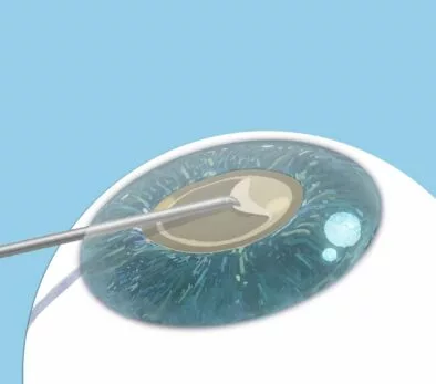 Ein Chirurg führt eine Nadel in ein Auge ein.