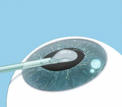 Eine Illustration eines Auges mit einer Nadel darin.