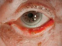 Eine Nahaufnahme des Auges eines Mannes mit Blut darauf.